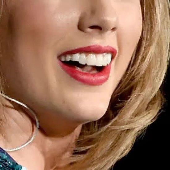 Taylor Swift消失的“小缺牙”，明星都在做的牙齿贴面有多神？ - 4