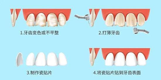 牙齿贴面的操作流程