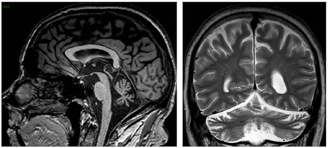 多图多表丨一文总结：小脑疾病的临床和影像学表现 - 8
