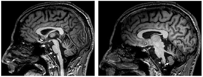 多图多表丨一文总结：小脑疾病的临床和影像学表现 - 17