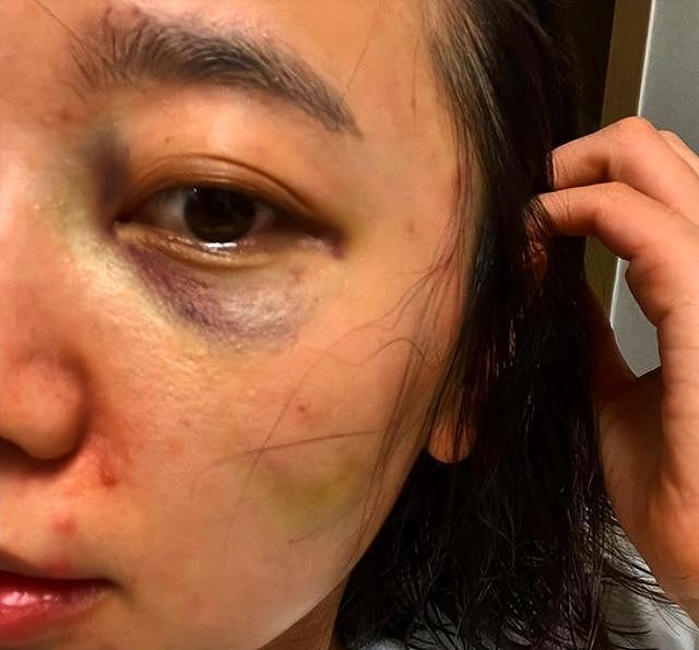 韩女星自曝遭家暴，眼圈受伤青紫，反被老公控诉婚内出轨 - 4