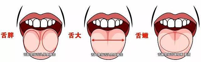 这样的齿痕舌：不仅仅提示气虚、湿气重，也提示脾胃虚弱！要注意 - 4