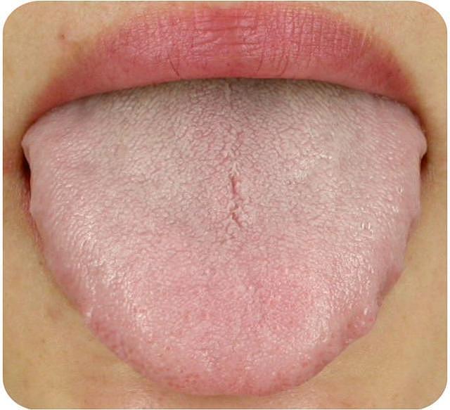 这样的齿痕舌：不仅仅提示气虚、湿气重，也提示脾胃虚弱！要注意 - 1