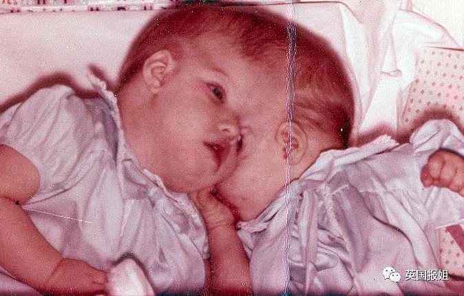 全球最知名连体双胞胎，多年姐妹竟变姐弟？ - 4