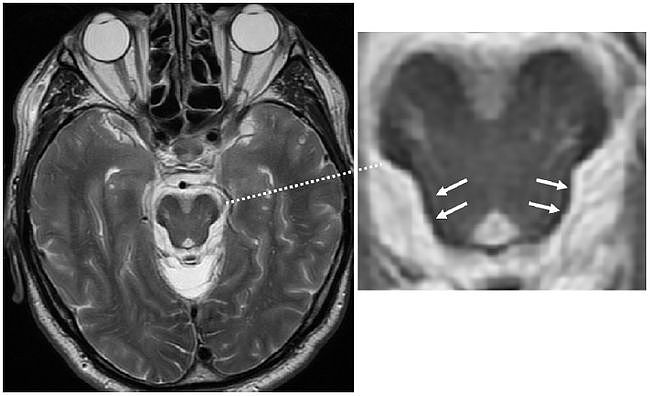 多图多表丨一文总结：小脑疾病的临床和影像学表现 - 9