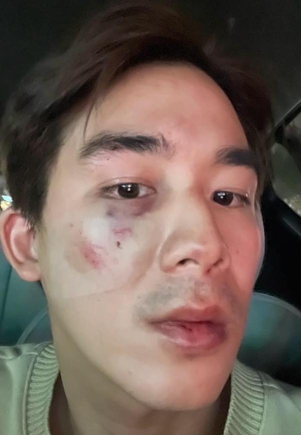 男星李博翔在街头被毒打伤势严重，女友上前劝架也遭殃 - 3