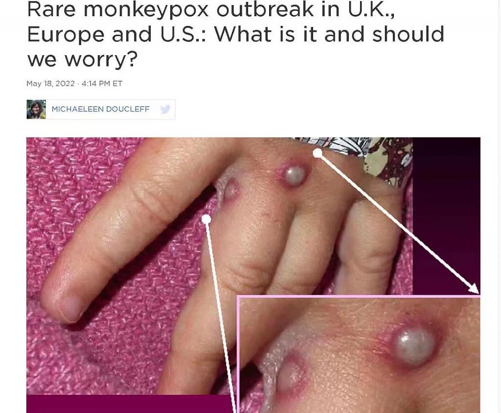 世卫组织预警！猴痘会成为下一个全球流行病吗？ - 2