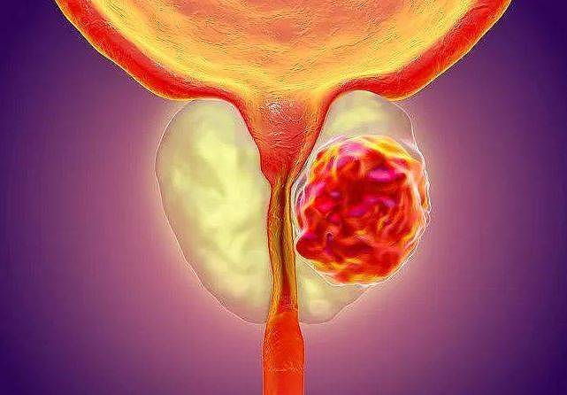 搜狐医药 | PARP抑制剂奥拉帕利在晚期前列腺癌的研究数据公布 - 1