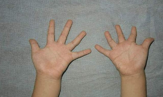 波兰式综合征是一种先天性疾病，表现在胸和手部，严重者可手术 - 4