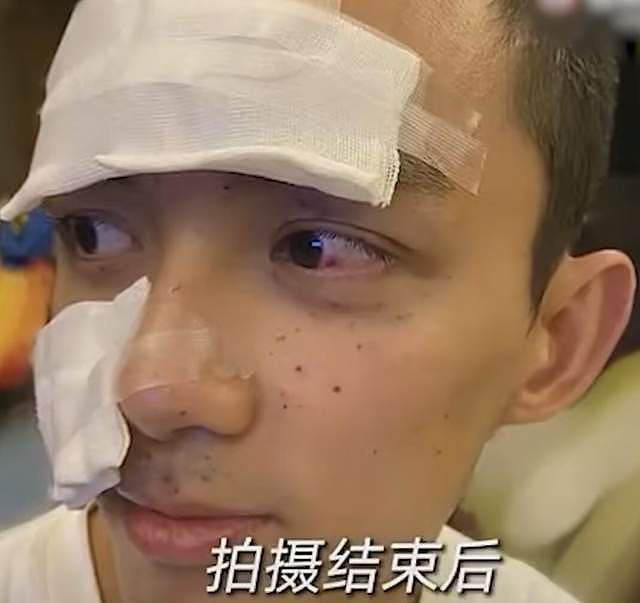 42岁李晨拍戏被炸伤！火药碎片扎入眼球，受伤后要求重拍吓坏吴京 - 16