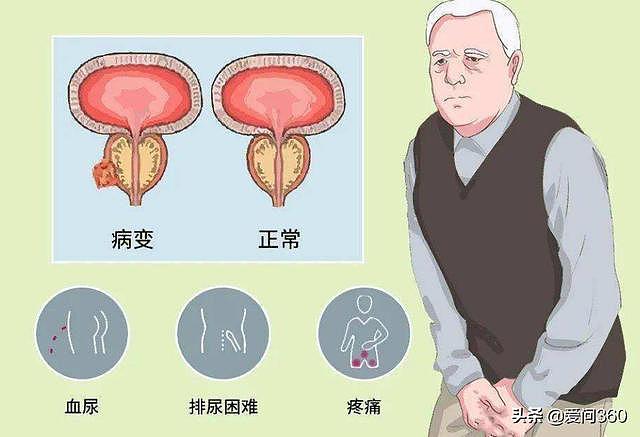 哪些行为对前列腺的危害最大？养护前列腺的几个小妙招教给你 - 2