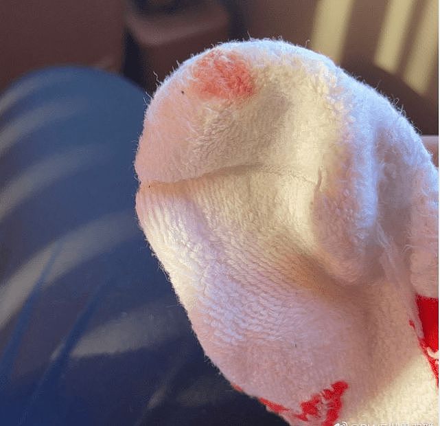 心疼!奥运冠军陈雨菲穿李宁球鞋比赛脚趾被割伤,白色球袜被血染红 - 3