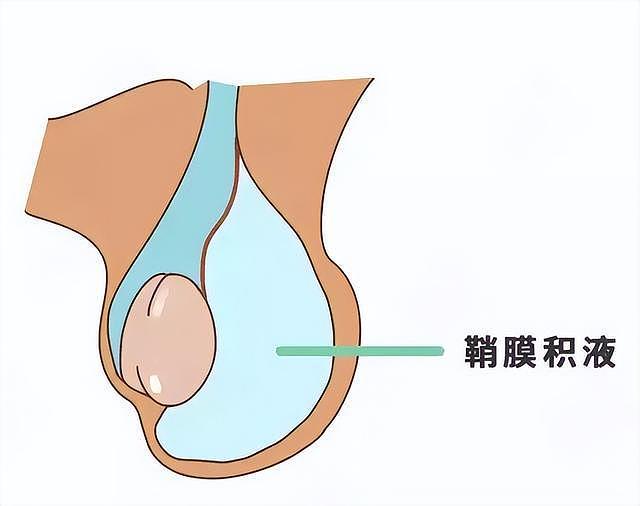 “蛋蛋”的烦恼之睾丸鞘膜积液 - 1