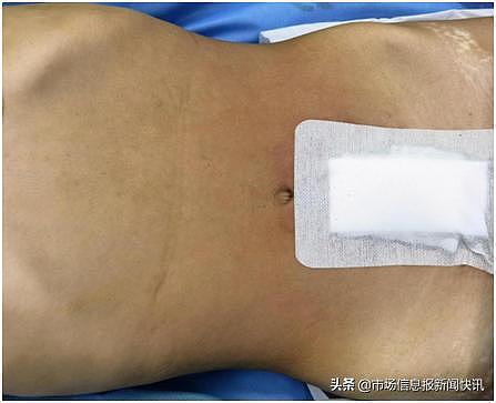 哈尔滨医科大学附属第二医院妇产科专家通过4cm切口成功摘除一28斤重、40cm长的巨大盆腹腔肿瘤 - 6