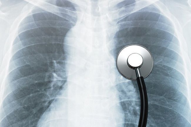 检查结果显示“肺部有阴影”，这是怎么回事？有这7种可能性 - 4