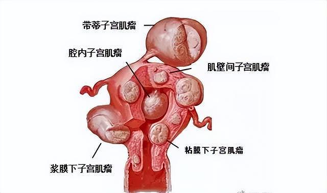子宫肌瘤就是一团痰湿，十几块的方子，帮你甩掉痰湿、消散肌瘤 - 3