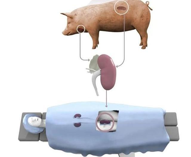前后准备3年，首例猪肾移植人体成功，“器官自由”还远吗？ - 2