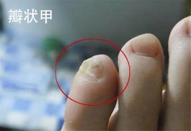 为什么有的人小脚趾指甲分两瓣？是纯种汉族人吗？ - 3