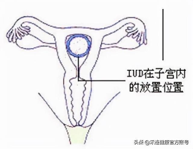 上环后一定要取环？70%中国女性都在用的避孕法，你一定要了解 - 2