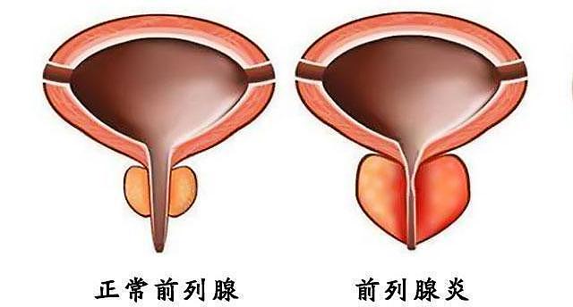 前列腺被称生命腺，医生提醒：男人50岁后，要警惕3类前列腺疾病 - 4