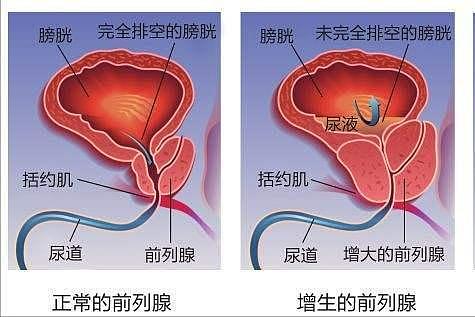 前列腺增生用经方五苓散合并桃核承气汤 - 3