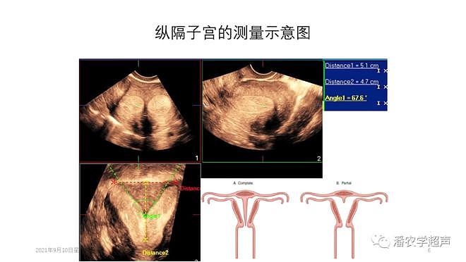 部分子宫畸形超声测量注意事项 - 6