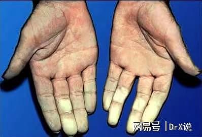 手指遇冷发白是冻伤？极易忽视的雷诺综合症，曾有人因此截肢保命 - 3