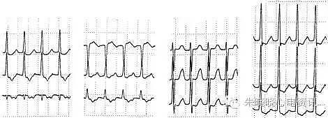 第六章 快速性心律失常的心电图诊断（浙江省心电图学专业岗位在职培训教材系列） - 10