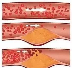 德国颠覆性研究：动脉硬化斑块并非来自血液中的脂肪 - 3