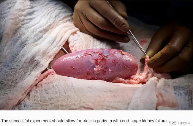 全球首例猪肾移植人体成功：这则新闻，能否改变数十万人的命运？ - 3