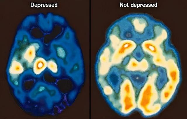 抑郁治疗康复防复发的指导思路：抑郁症是生理疾病还是心理疾病？ - 1