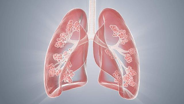 肺部有疾，喉咙先知？提醒：出现4种信号，别傻傻以为是咽炎 - 1