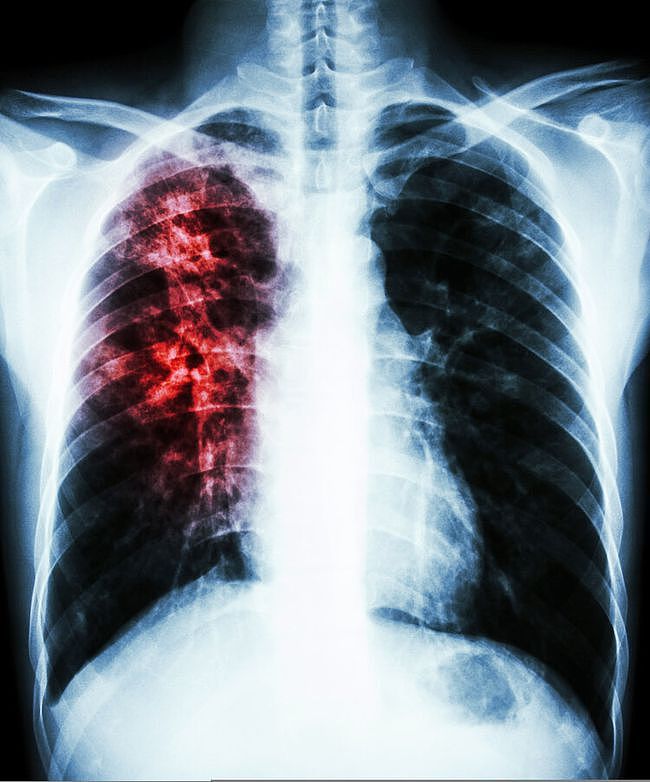 检查结果显示“肺部有阴影”，这是怎么回事？有这7种可能性 - 3