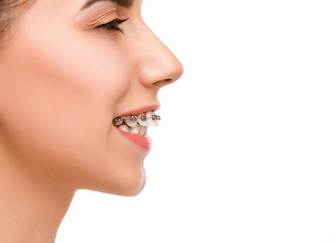 牙结石或会影响全身健康，提示：这3类人最好抓紧时间洗牙 - 4