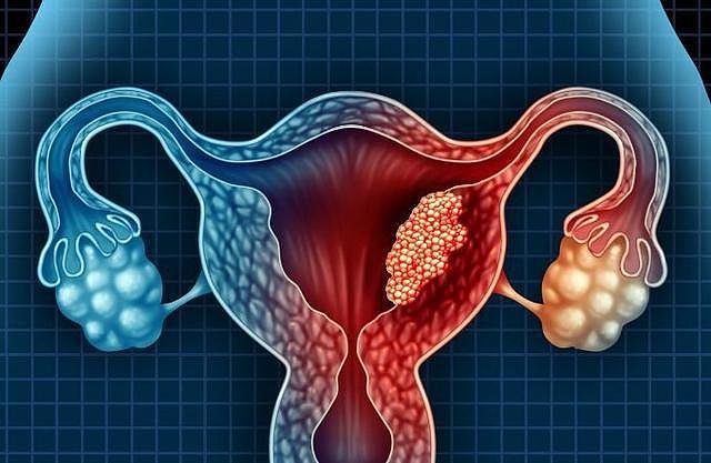 医生提醒：女人例假结束后，若有5个异常现象，或与宫颈问题有关 - 1