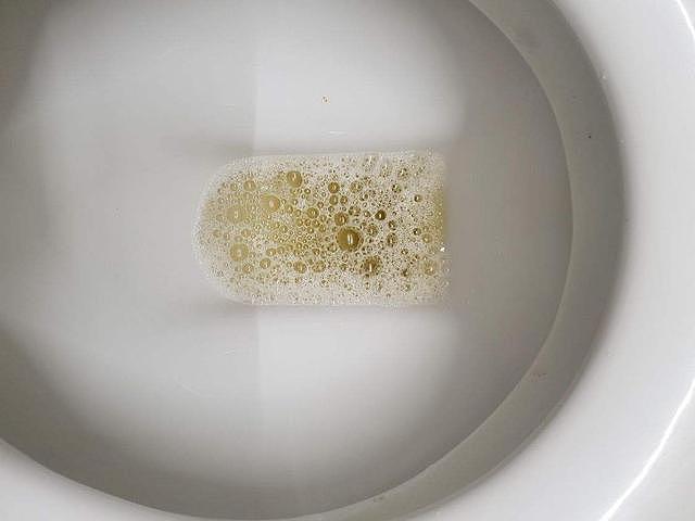 为什么有的尿液中有很多泡沫？这是尿毒症的症状吗？一文讲清 - 2