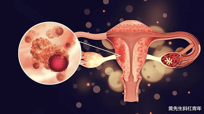 子宫内膜异位症与卵巢癌之间的遗传联系！ - 1