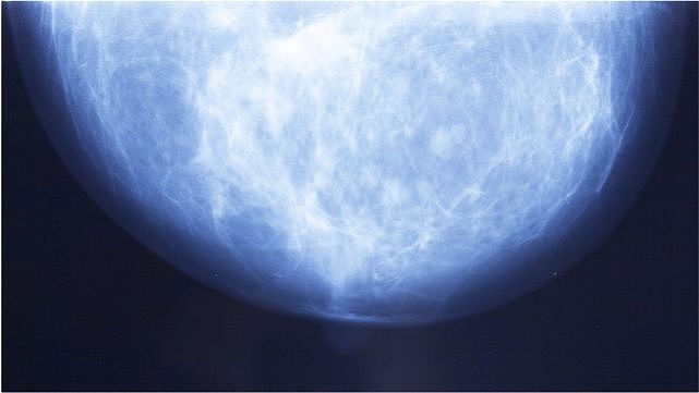 乳腺体检中的“钙化灶”是什么意思？如果不管它，会怎么样？权威专家解说 - 1