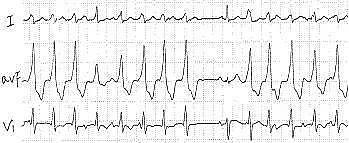 第六章 快速性心律失常的心电图诊断（浙江省心电图学专业岗位在职培训教材系列） - 12