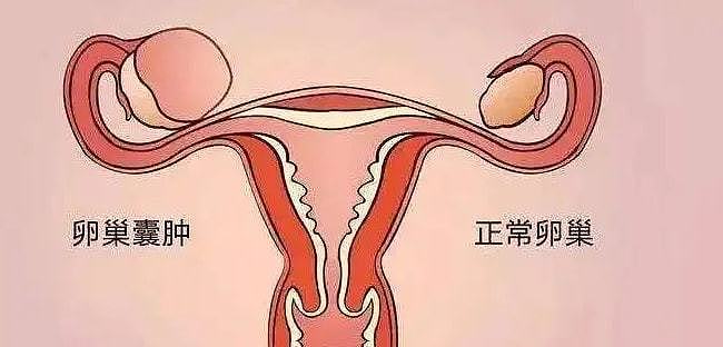 卵巢囊肿很大几率是这几种原因，请对号入座 - 1