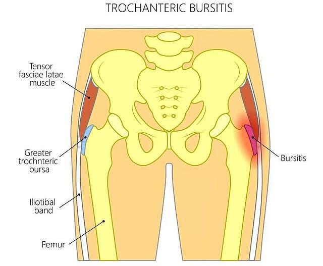 什么是大转子滑囊炎？出现臀部外侧的5种疼痛，需提高警惕 - 3