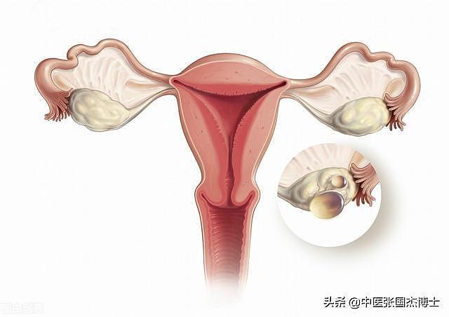 5.5公分的卵巢囊肿，巧用张仲景千古名方，不手术也能消除 - 1