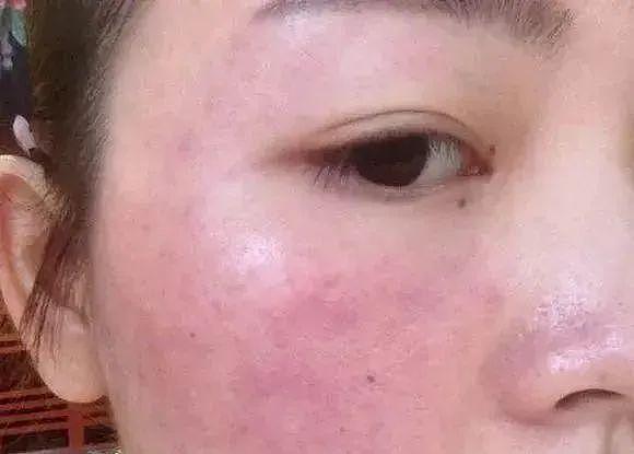 皮肤科医生揭秘：药店有一种擦脸的，16天淡色斑，可惜很少人知道！ - 28