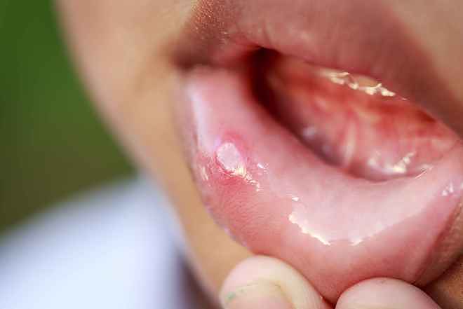 口腔溃疡总是反反复复？提醒：遇到这5种溃疡，警惕口腔癌的到来 - 1