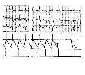 第六章 快速性心律失常的心电图诊断（浙江省心电图学专业岗位在职培训教材系列） - 6