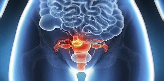 卵巢肿瘤是一种什么样的疾病？卵巢肿瘤在术后复查应该注意什么？ - 4