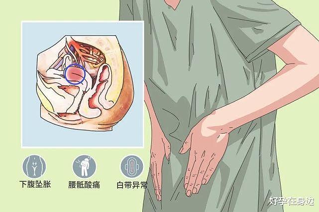 女性肚子经常痛，可能是慢性盆腔炎 - 2