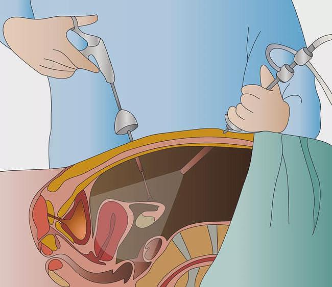 试管小白——宫腔镜与腹腔镜，是检查也是手术 - 3