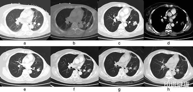 CT引导下微波消融治疗乳腺癌肺转移患者：有效率高达97.8%！ - 3