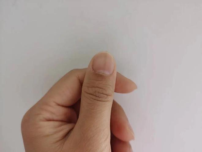 指甲上的竖纹是肝病引起的？其实也可能是这3个原因，不必担心 - 1